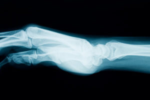 一个女人的手和胳膊的x光片