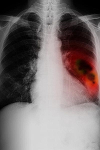 肺癌x光片